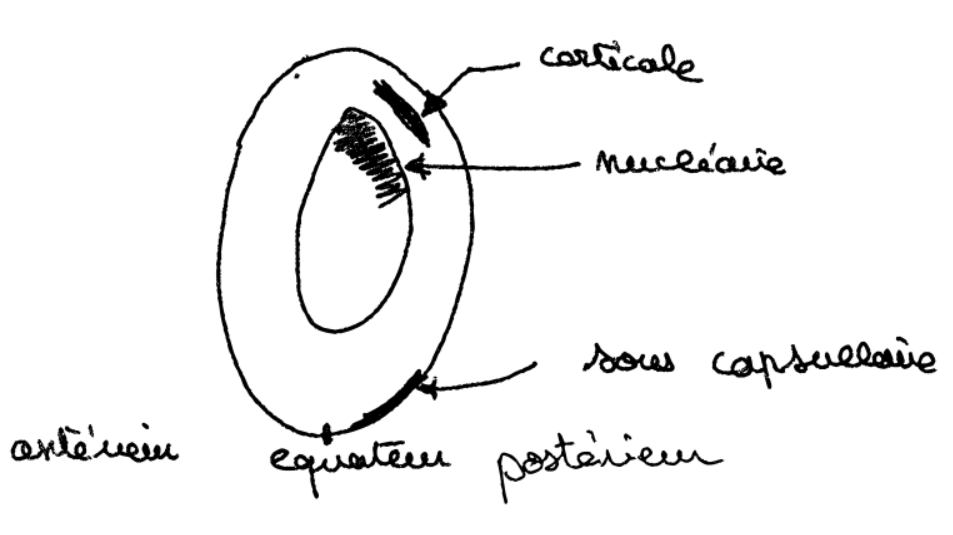 Localisation cataracte cristallin.png